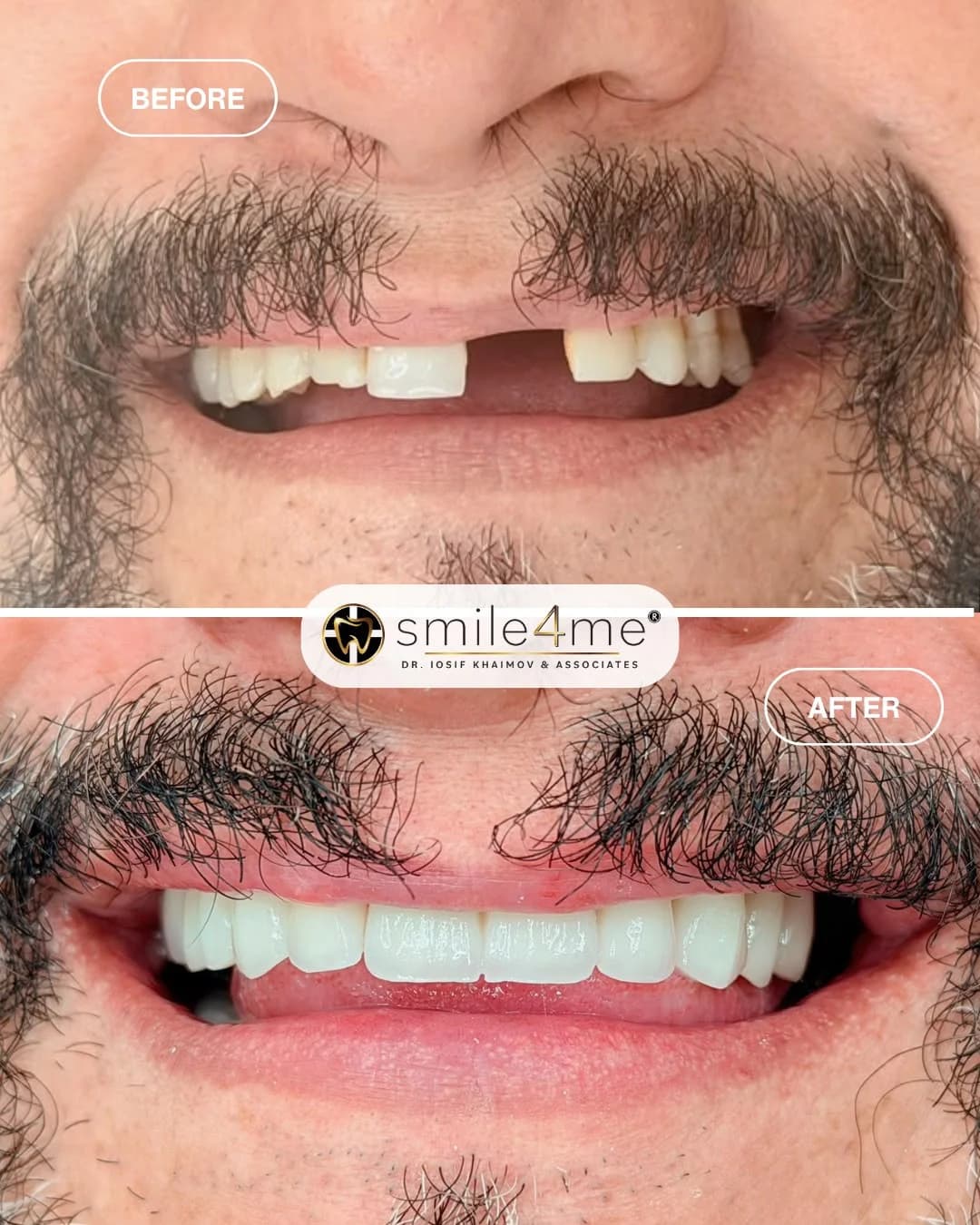 Photo of before and after smile showing a front tooth gap restored with white teeth