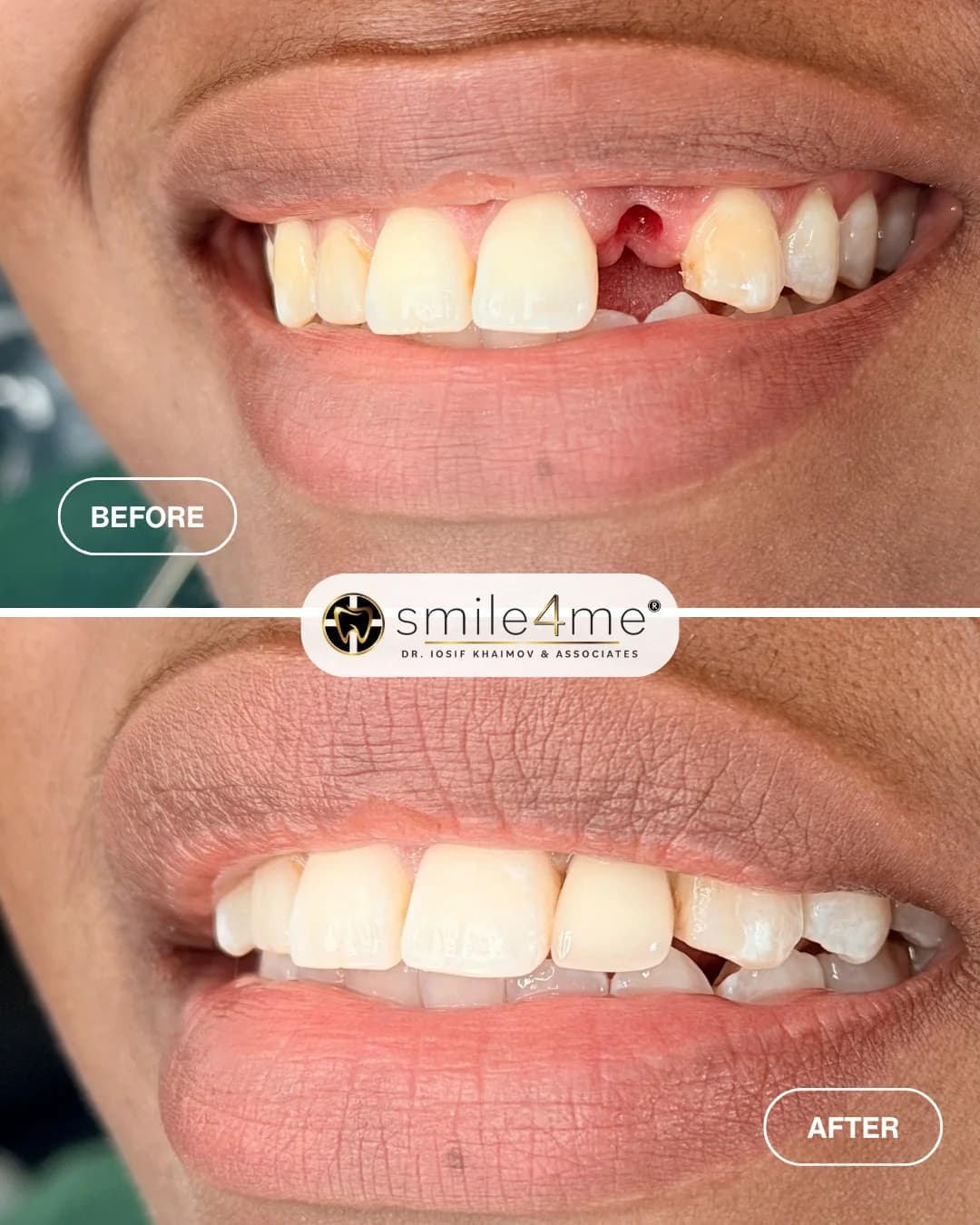 Photo of before and after smile showing a missing front tooth replaced