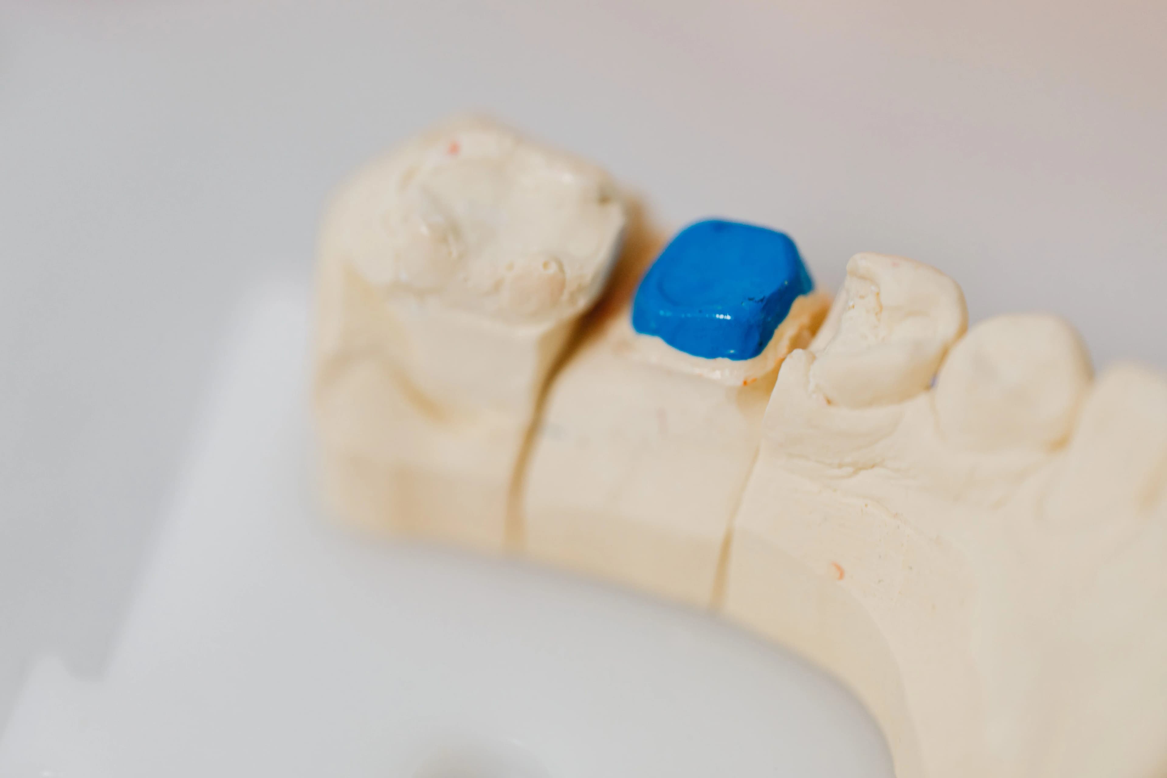 Photo of dental model with blue restoration for inlays and onlays Queens