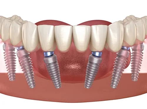 All on 6 Dental Implants Astoria