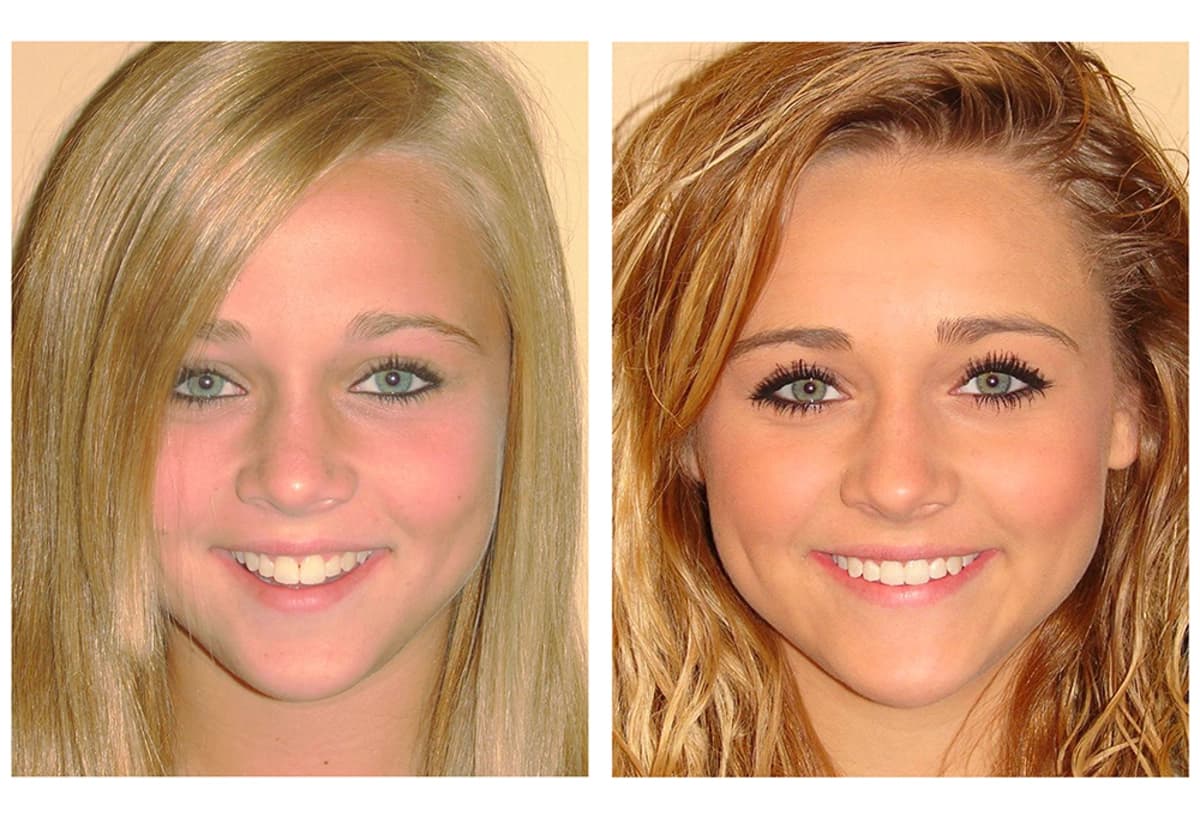 Before and After