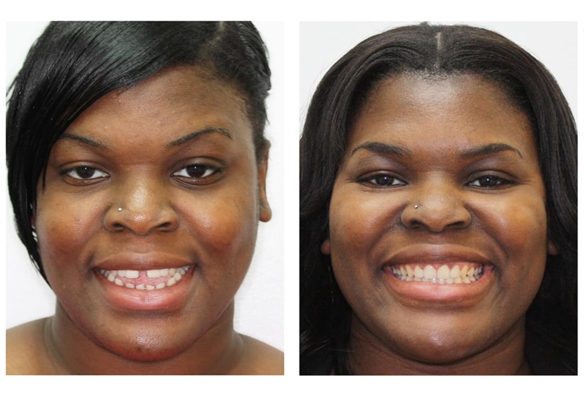 Invisalign-before-and-after-showing-a-woman-with-improved-tooth-alignment-straighter-smile-and-healthier-teeth-after-invisalign-treatment