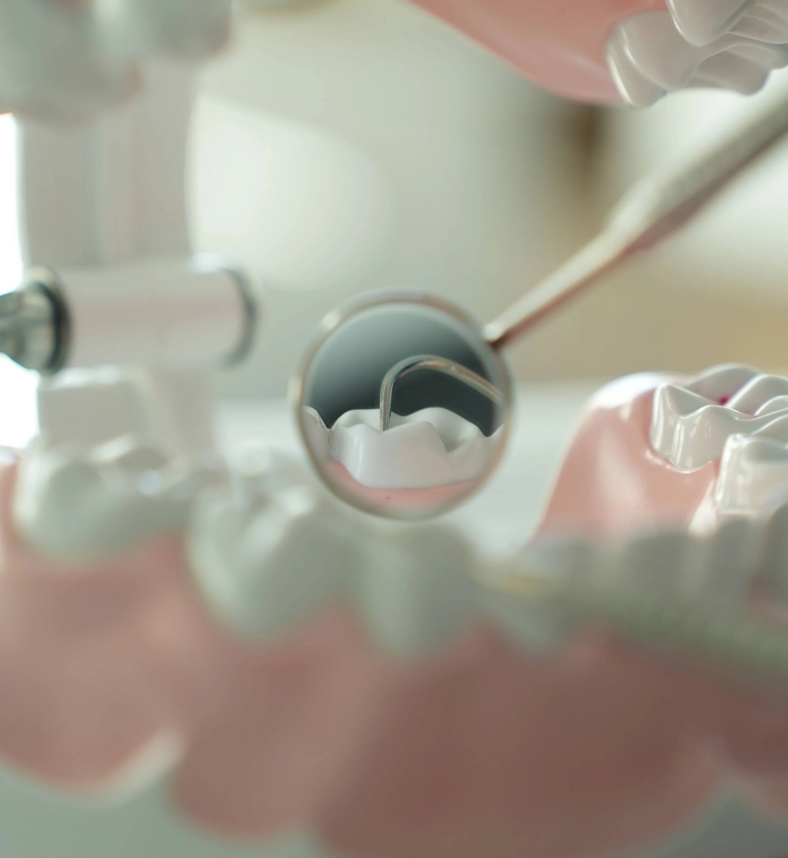 Photo dental model demonstrating dental fillings in Astoria with mirror