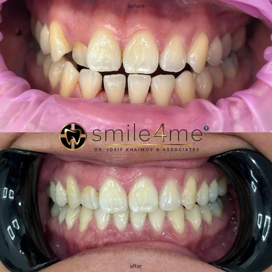 Photo of crowded teeth before and after alignment treatment