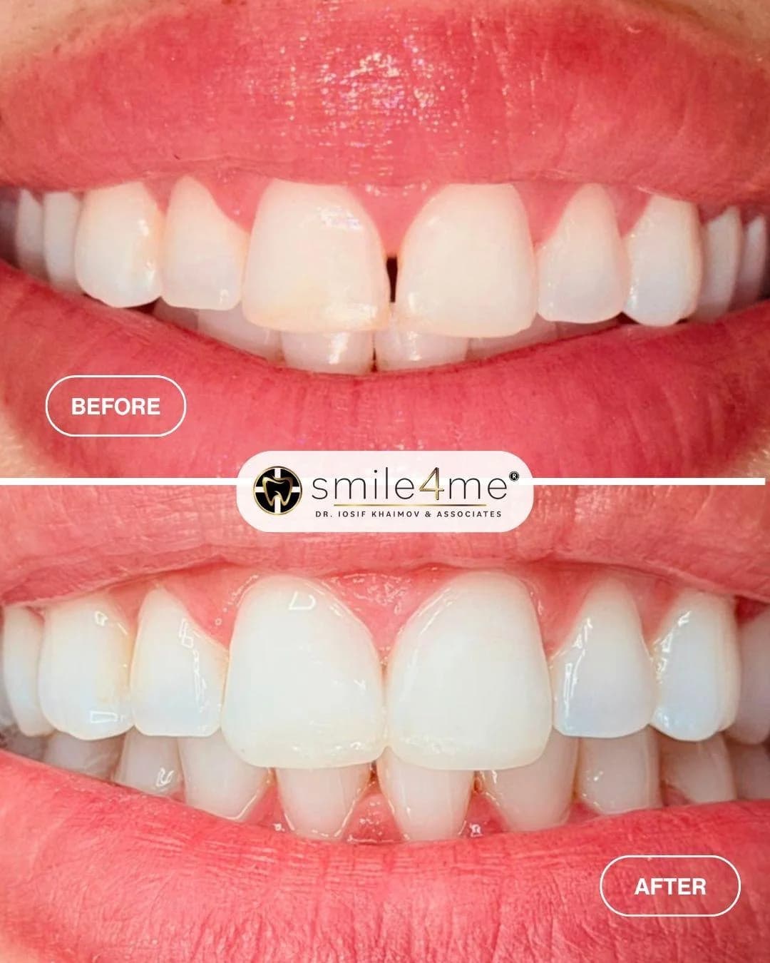 Photo of front teeth before and after closing a gap