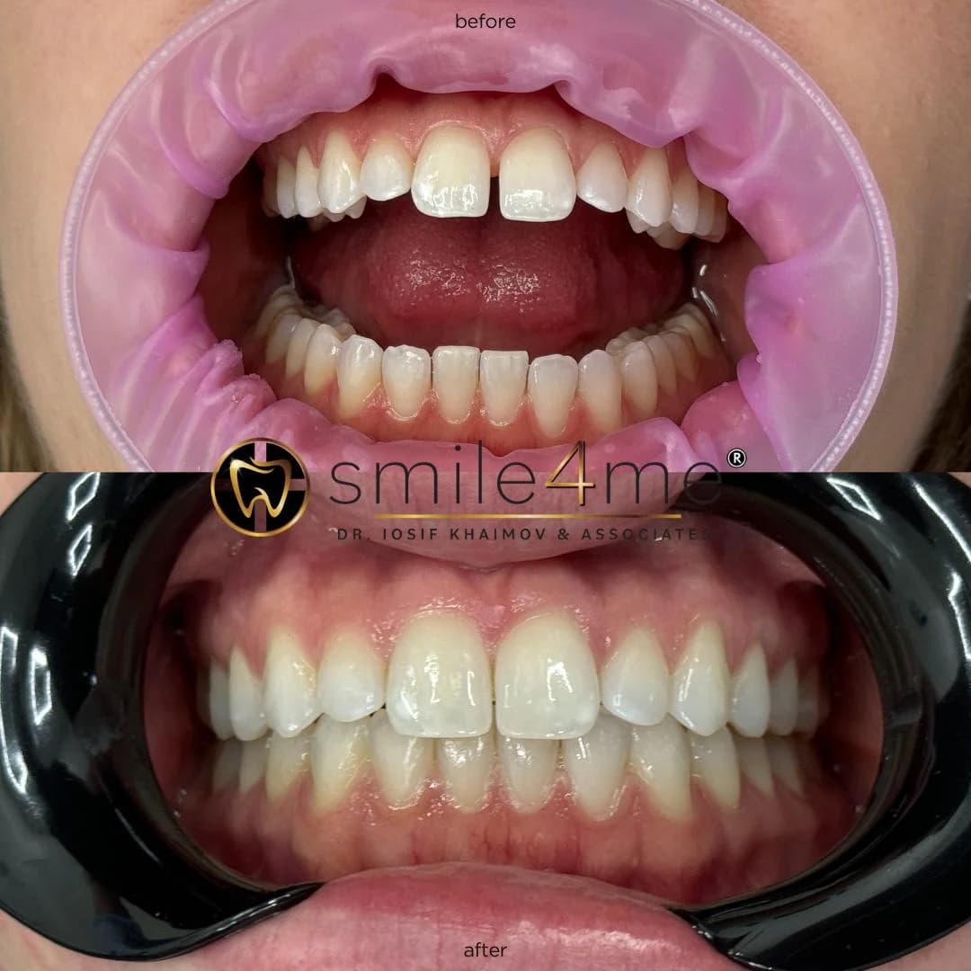 Photo of teeth before and after alignment treatment