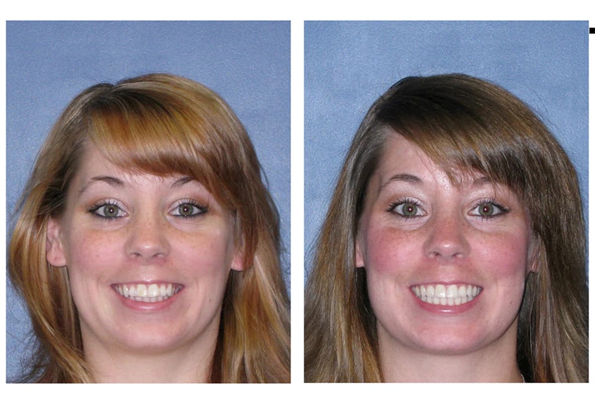 Before and After