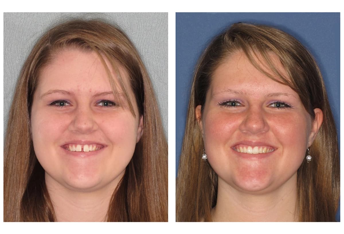 Before and After
