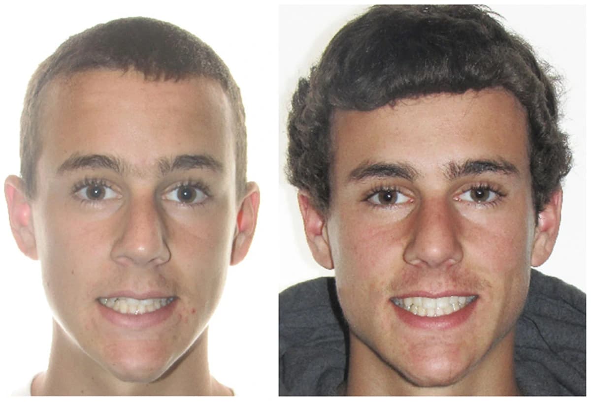 Before and After