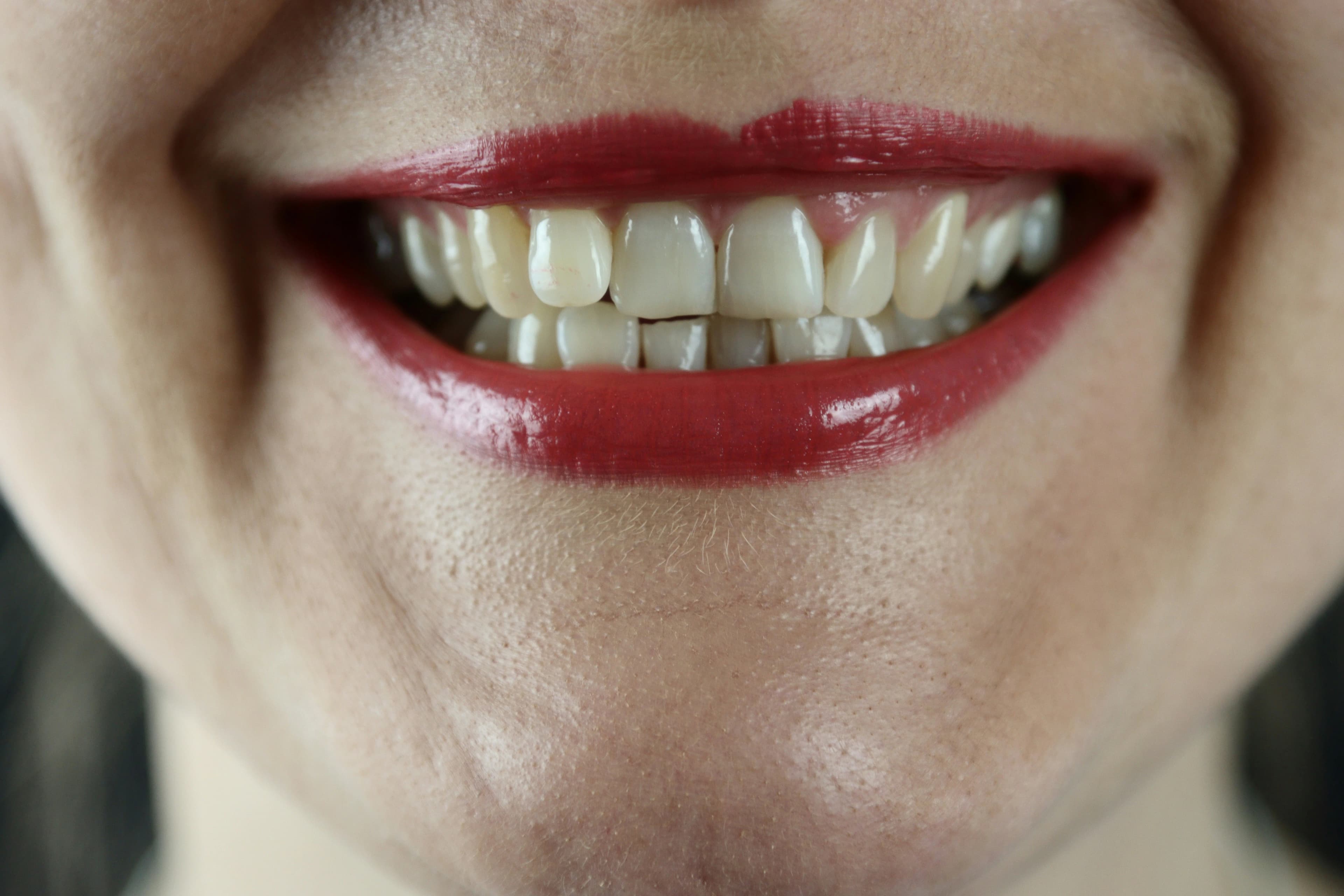 Understanding the Causes of Tooth Stains and Discoloration