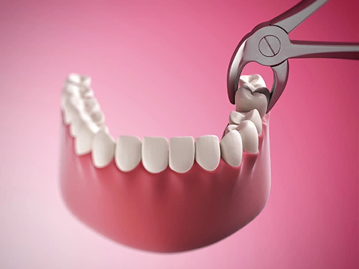 Dental forceps removing tooth from lower jaw model against pink background representing affordable dental extractions procedures