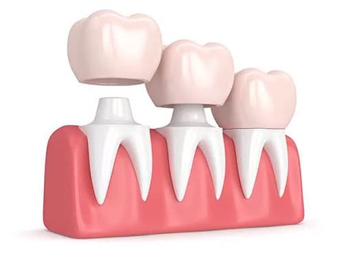 Illustration of three dental crowns on implants above gums representing same day crowns Astoria restoration process