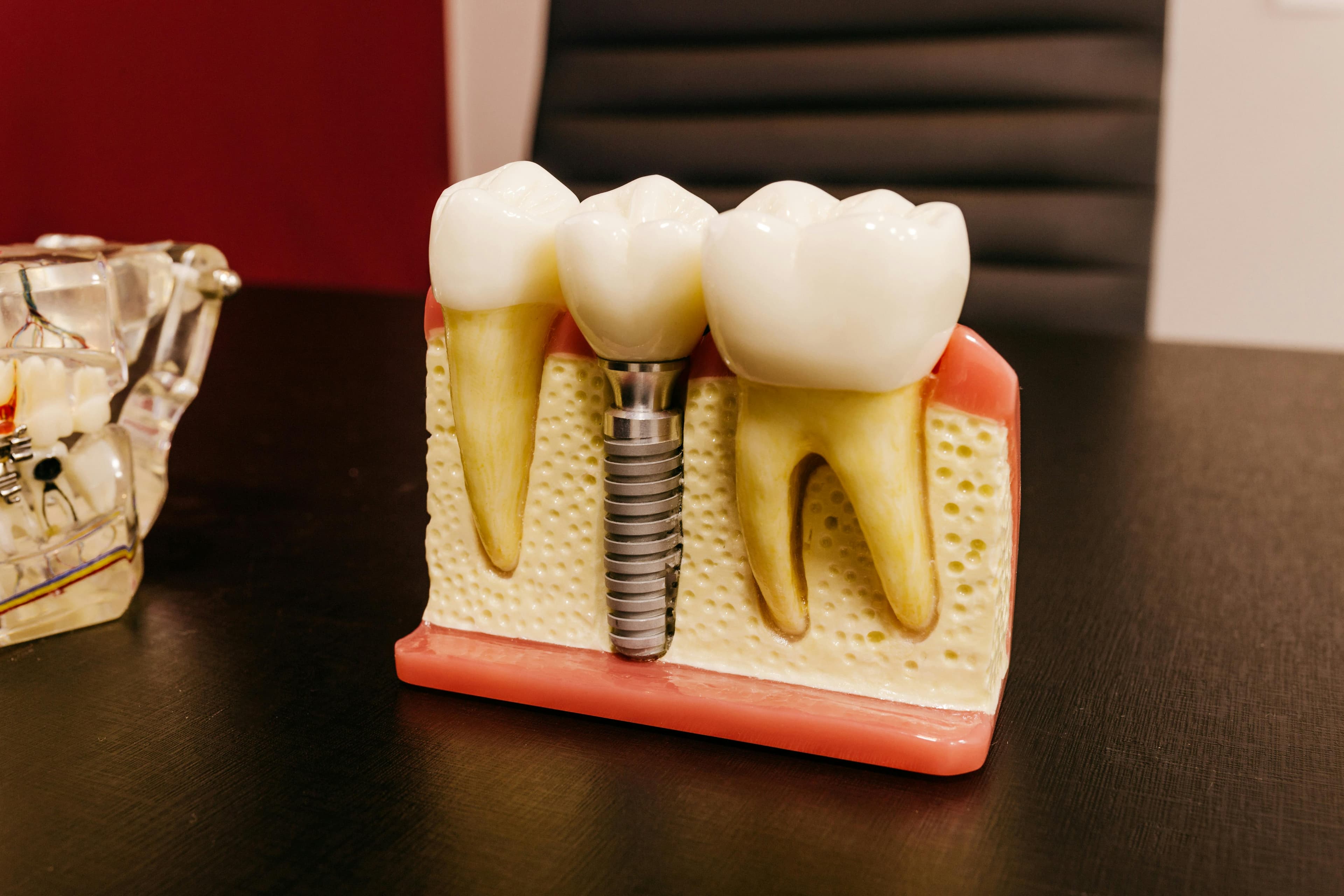 How Long Do Dental Implants Last Dental Implant Model With Crown And Screw Between Teeth