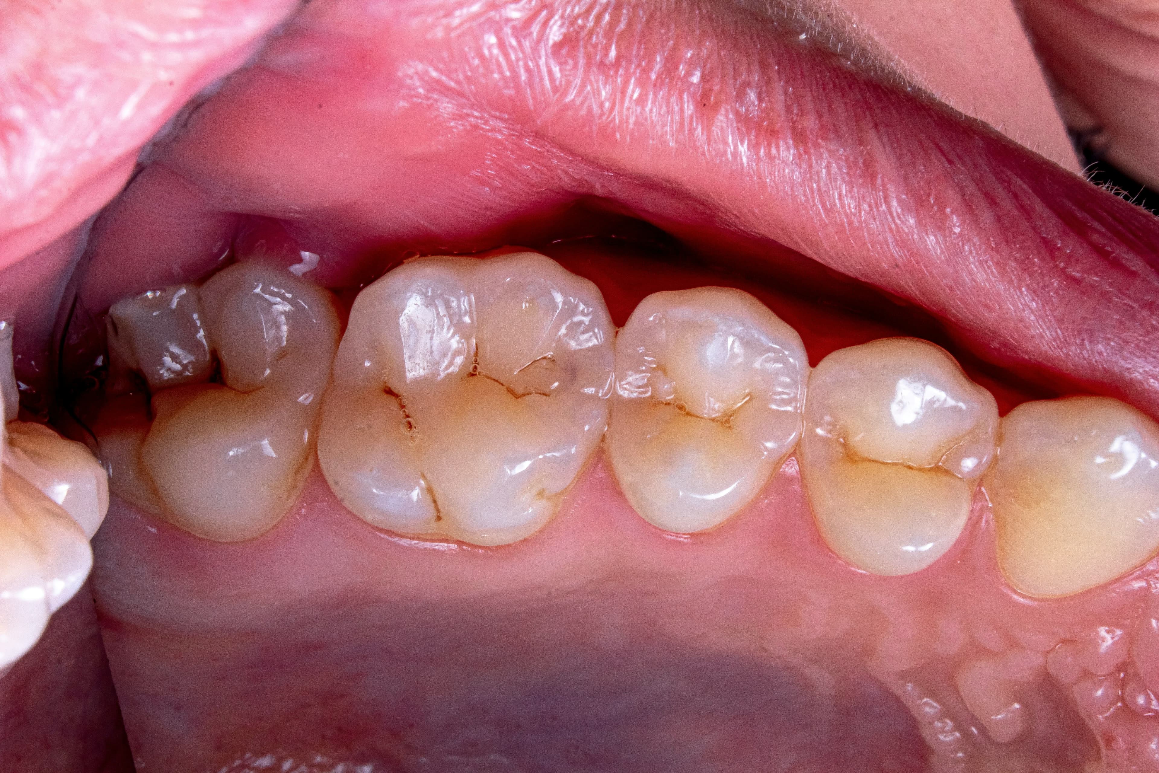 Close Up Molars With Visible Cracks And Gum Tissue Showing Why Is A Cracked Tooth An Emergency
