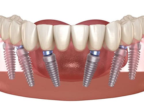 How Long Do All On 6 Implants Last Illustration Of Lower Jaw With Six Dental Implants Supporting Fixed Full Arch Bridge