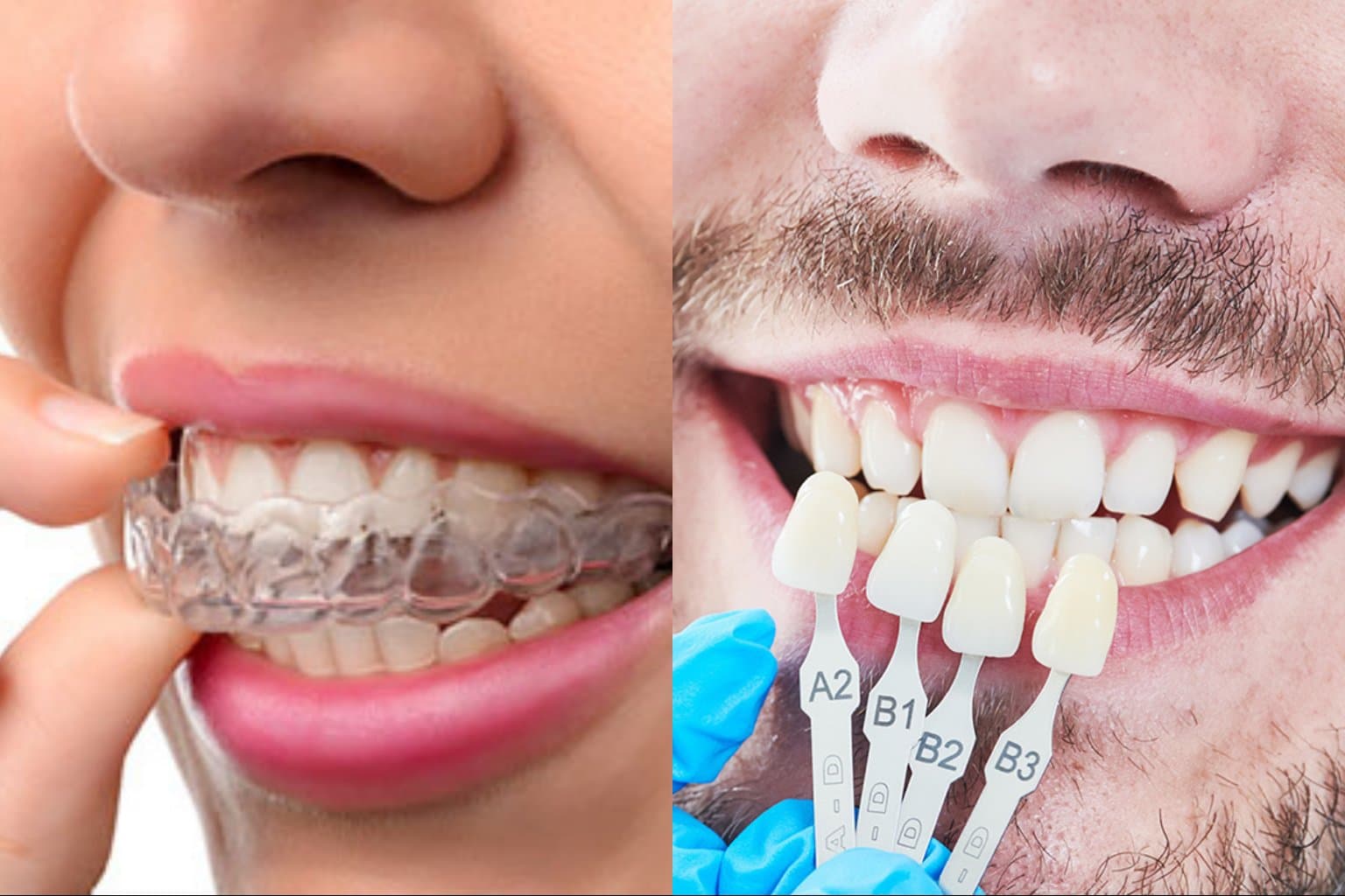 Photo Side By Side Smile Showing Clear Aligner On Teeth And Dentist Holding Shade Guide For Invisalign Vs Veneers Comparison