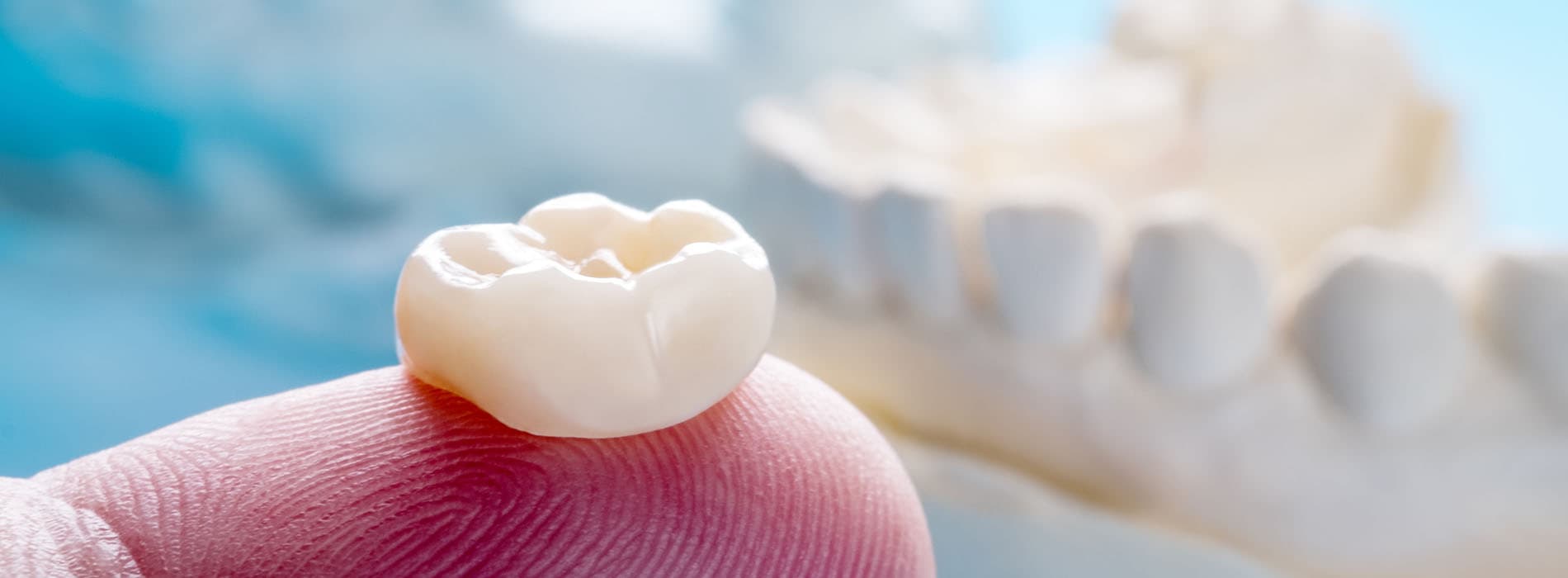 Photo Of Dental Crown On Fingertip With Blurred Teeth Model In Background Showing Is A Crown Falling Off A Dental Emergency Concern