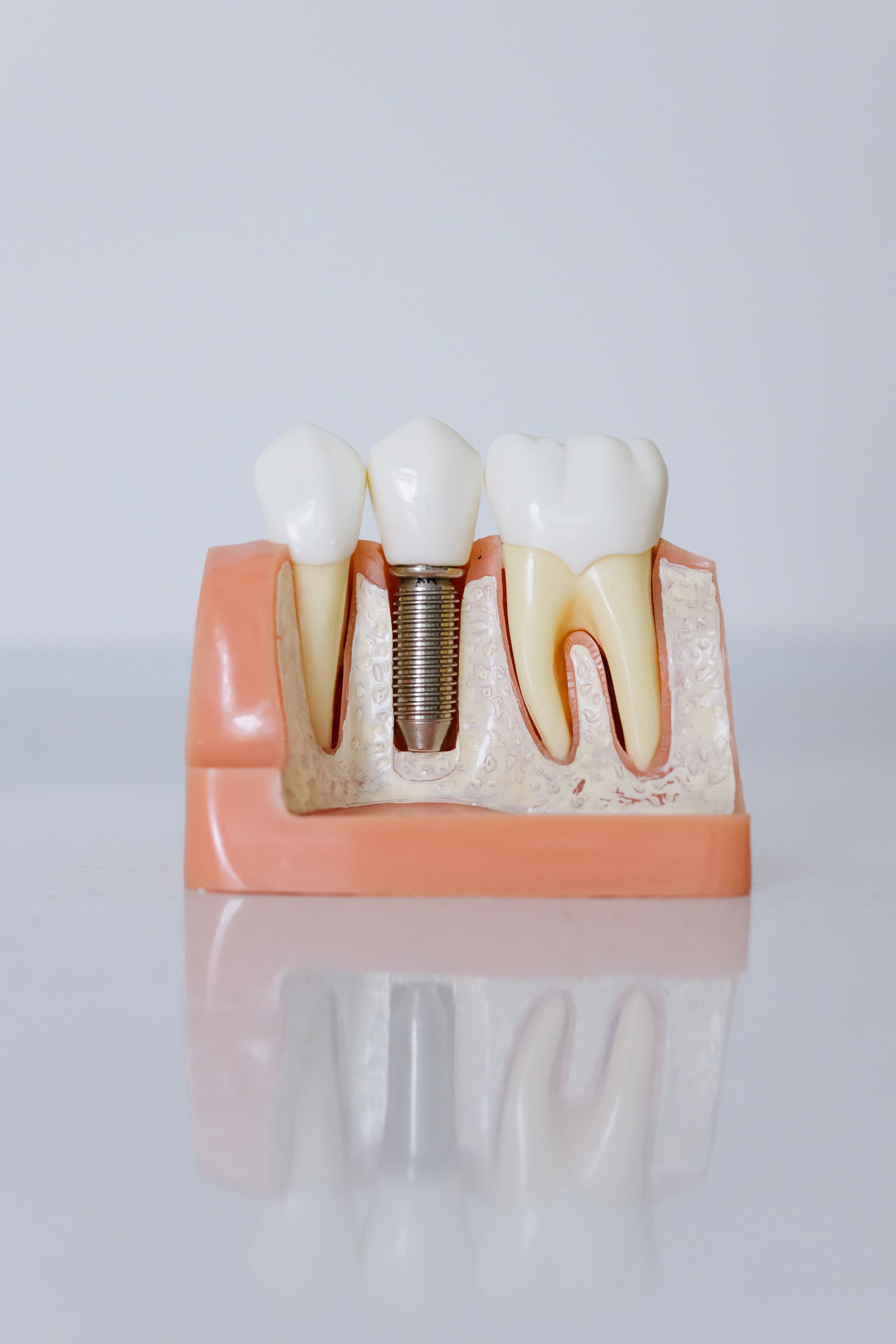 How Does The One Day Implant Process Work