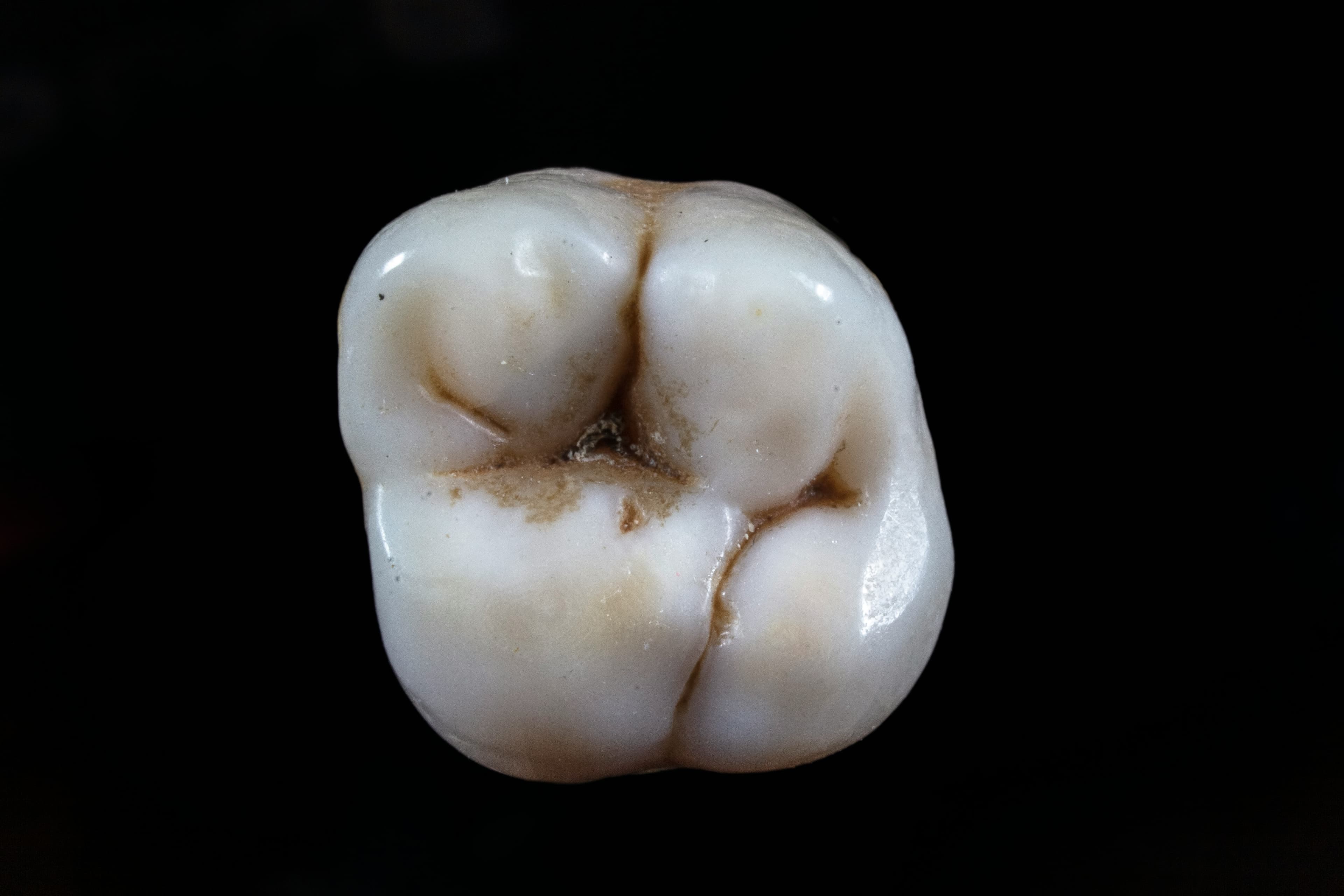 Photo Molar With Dark Grooves Is A Black Tooth An Emergency