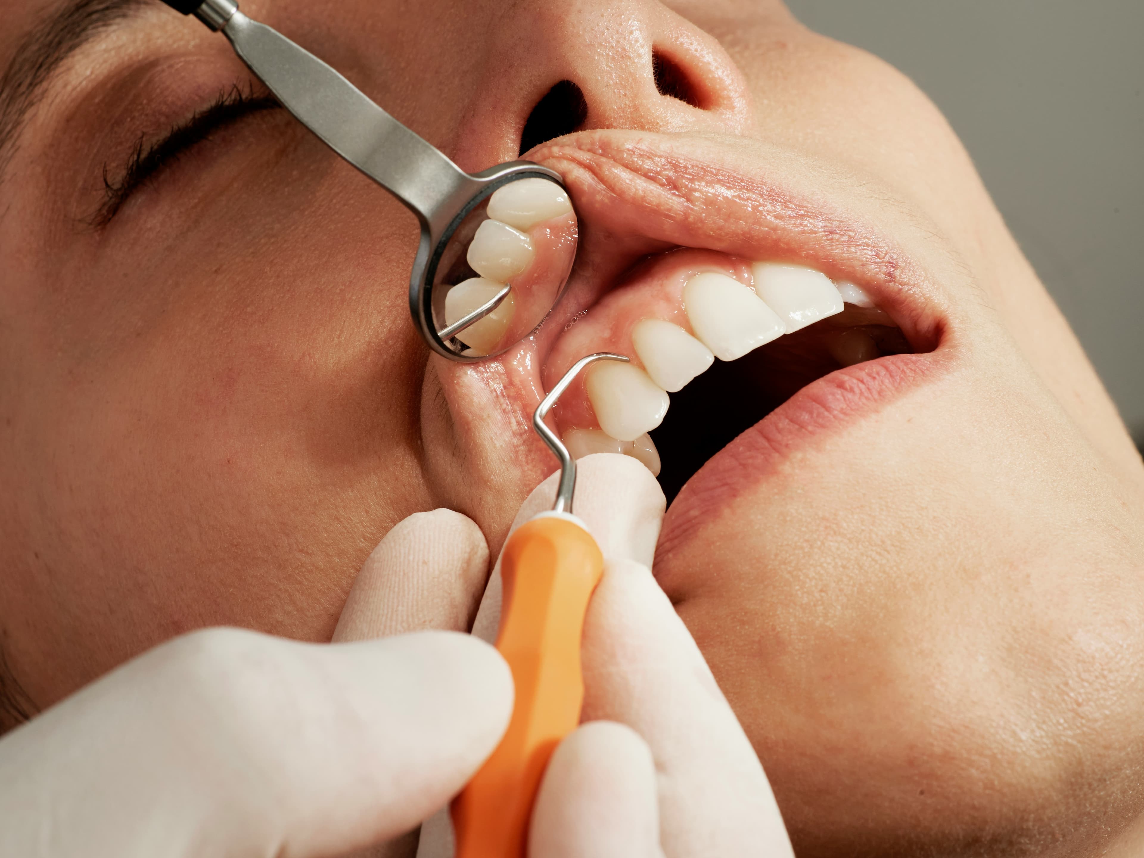 Photo Dental Mirror Examining Teeth During Dental Implant Process Timeline