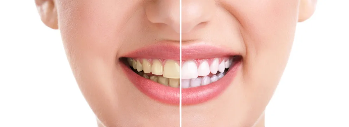 Close Up Of A Smiling Woman Showing Before And After Teeth Color Comparison Demonstrating How To Improve Your Smile With Professional Teeth Whitening Treatment