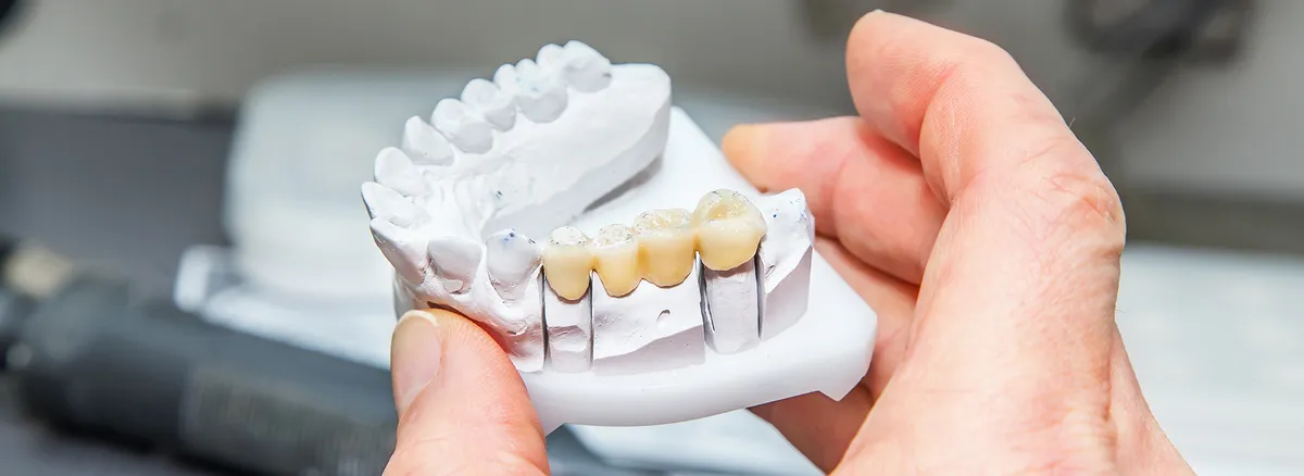 Hands Holding A Dental Model Showing A Bridge With Several Teeth Mounted On Implants For Dental Implant Restoration