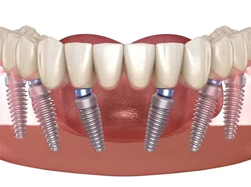 3d Illustration Of A Full Upper Arch Of Teeth Supported By Six Dental Implants Secured In The Gums
