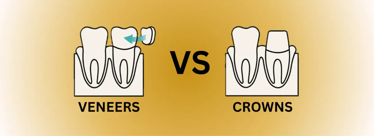 Two Tooth Diagrams Showing Difference Between Veneers And Crowns With Veneer Covering Front Of Tooth And Crown Encasing Entire Tooth On Gold Background