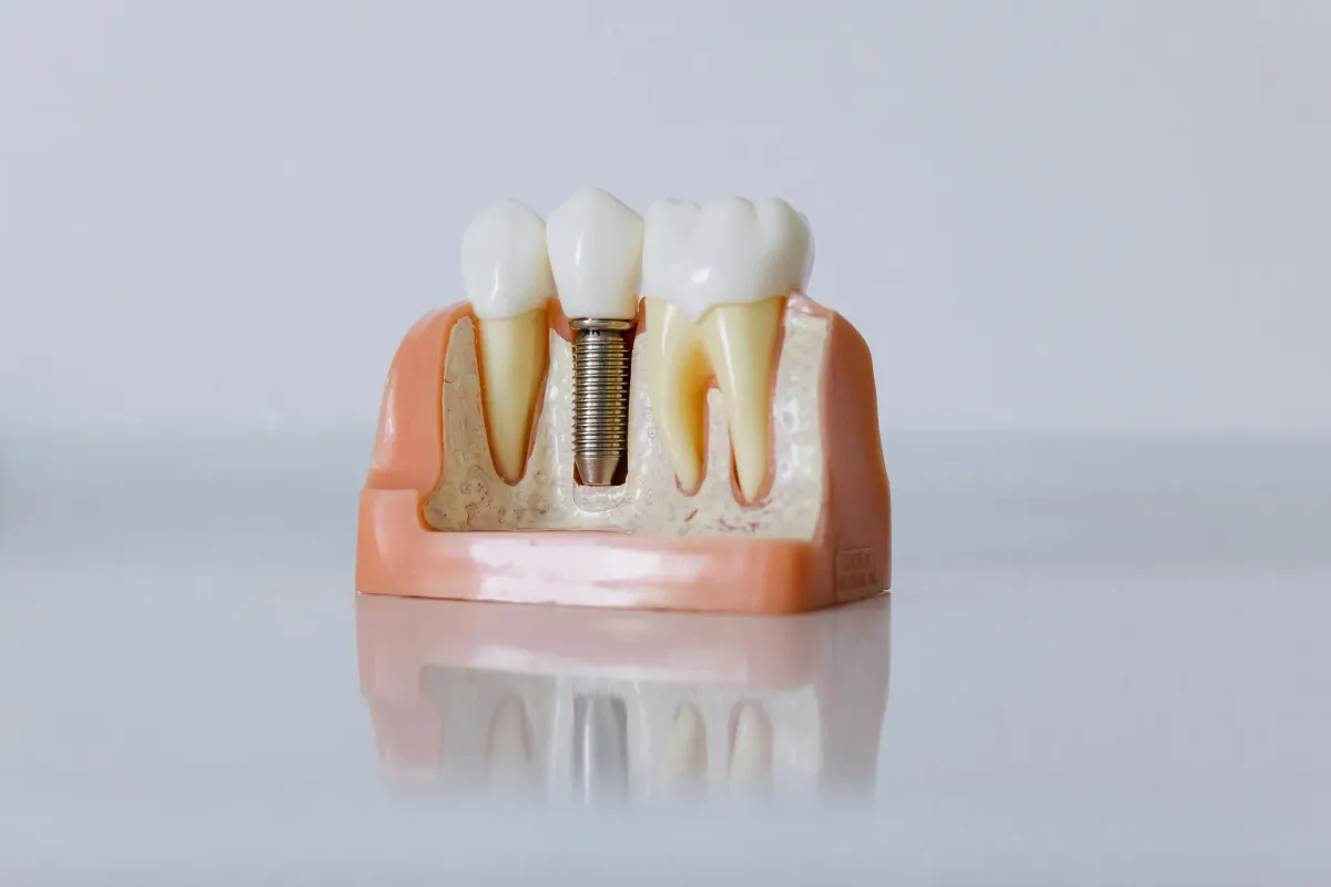 Dental Implant Model Showing Implant Post Surrounded By Natural Teeth Used To Educate Patients On Proper Maintenance Of Dental Implants For Long Term Oral Health
