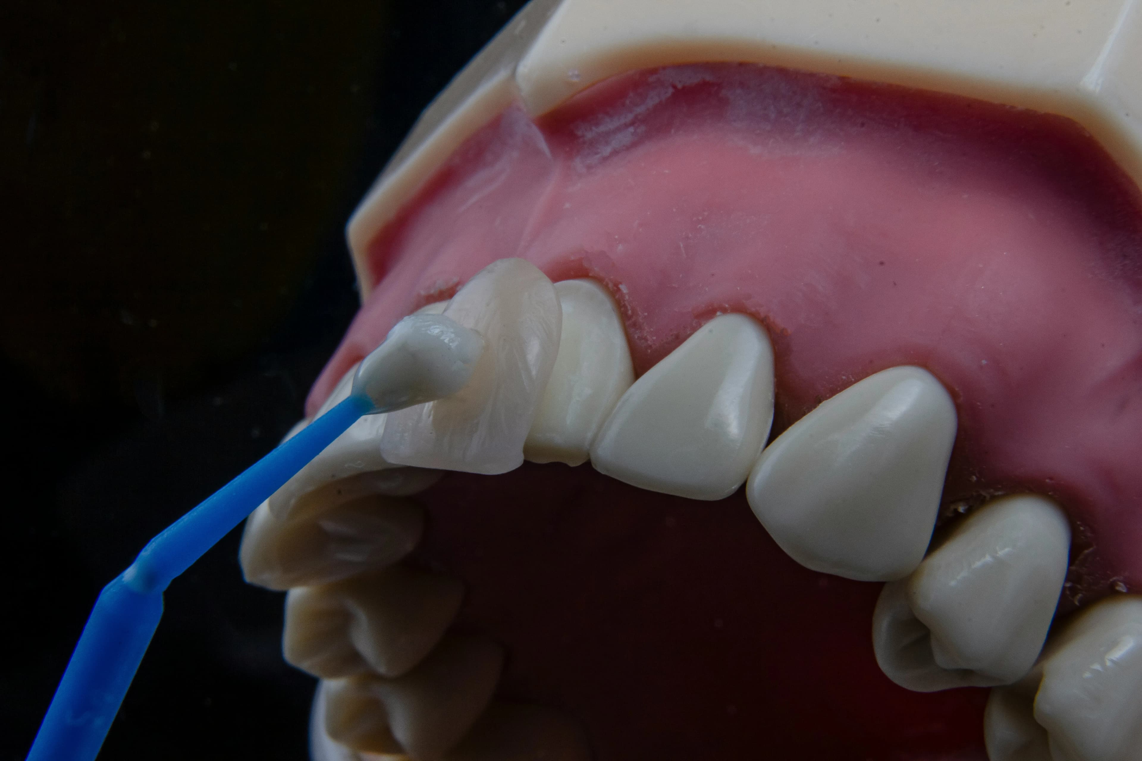 How Much Do Veneers Cost?