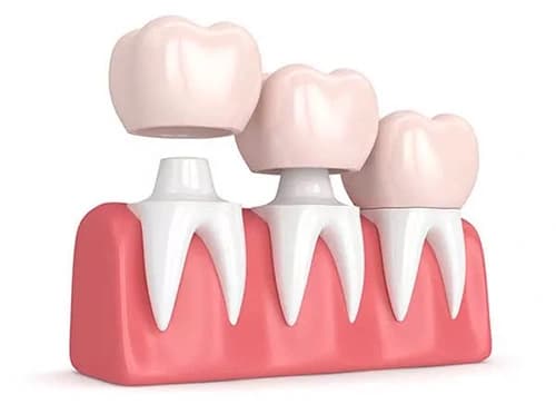 What is a Dental Crown?