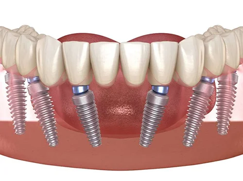 3D rendering of lower jaw showing full arch tooth replacement using all on 6 dental implants with six titanium posts supporting prosthetic teeth.