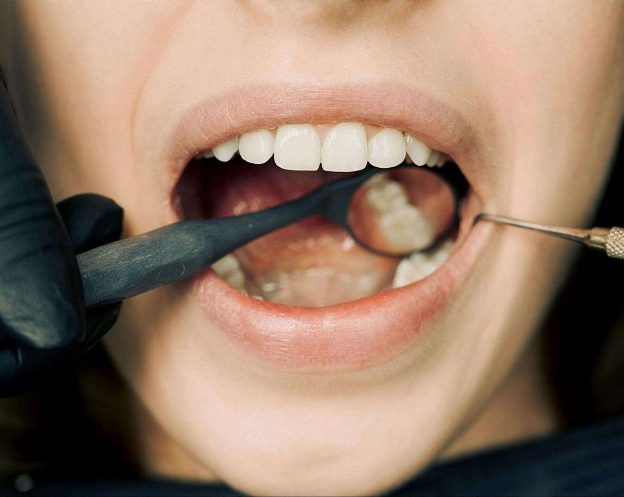 Close-up of dental checkup with tools inside mouth examining back teeth for signs of tooth implant infection and other oral health issues.
