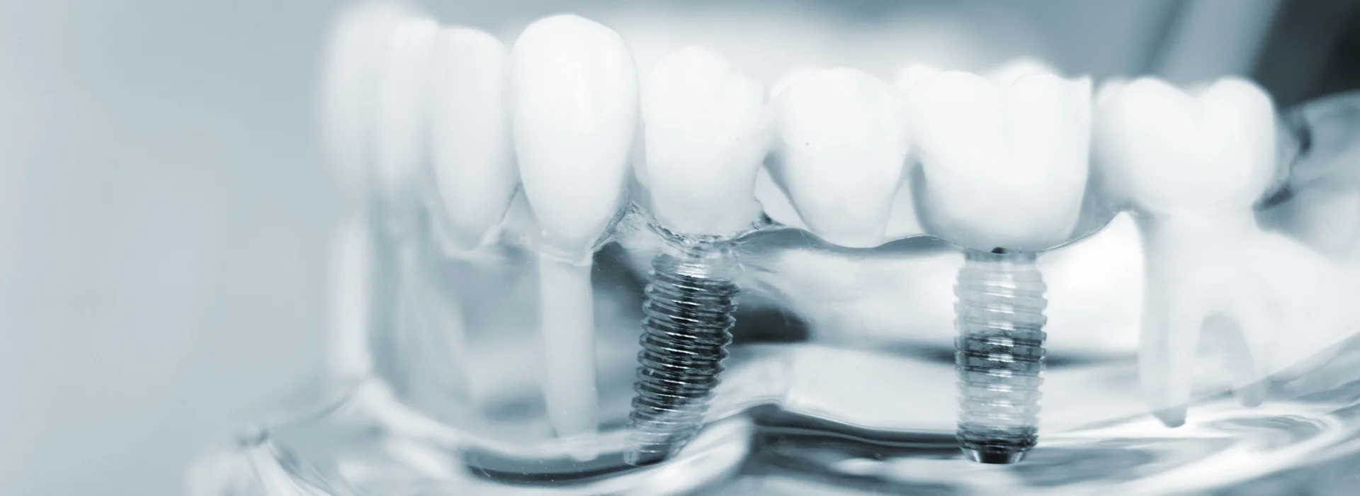 Close up of transparent dental model showing teeth attached to metal implants demonstrating proper implant placement and tooth structure.