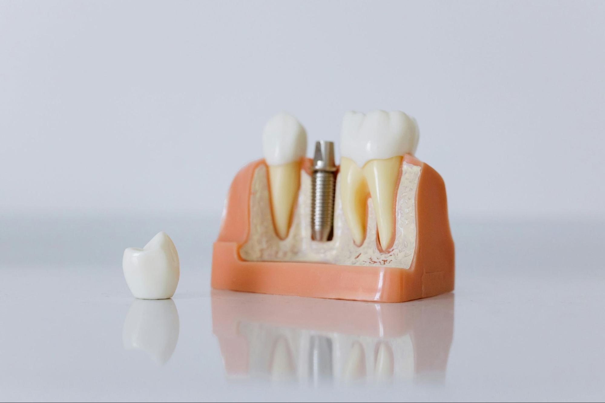 Cross section model showing components of dental implants including metal post, abutment, and crown alongside a separate tooth cap on white background.