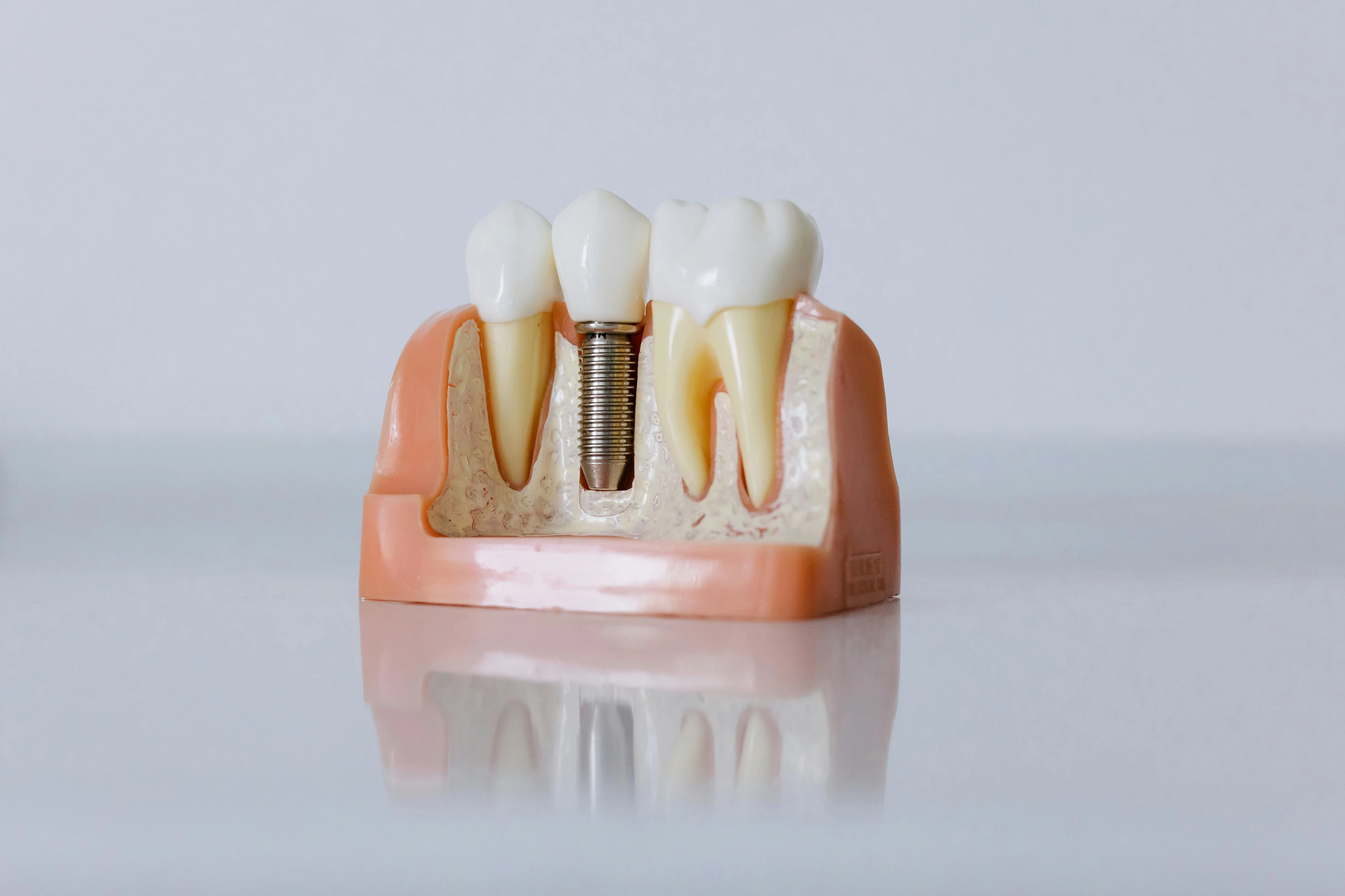 Dental implant model showing implant post surrounded by natural teeth used to educate patients on proper maintenance of dental implants for long term oral health.
    