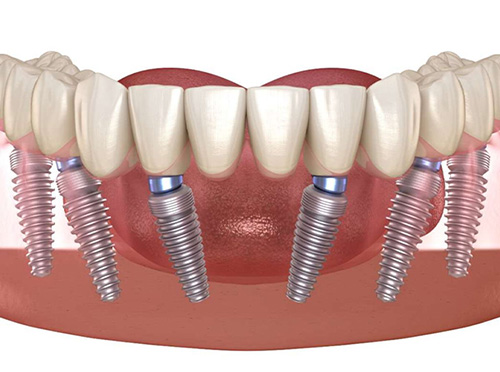 Digital rendering of lower jaw showing six angled dental implants supporting fixed prosthetic teeth.