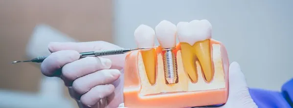 Gloved hand pointing at tooth model showing dental implant placement to explain how a dental implant fell out and what it looks like inside the gum.