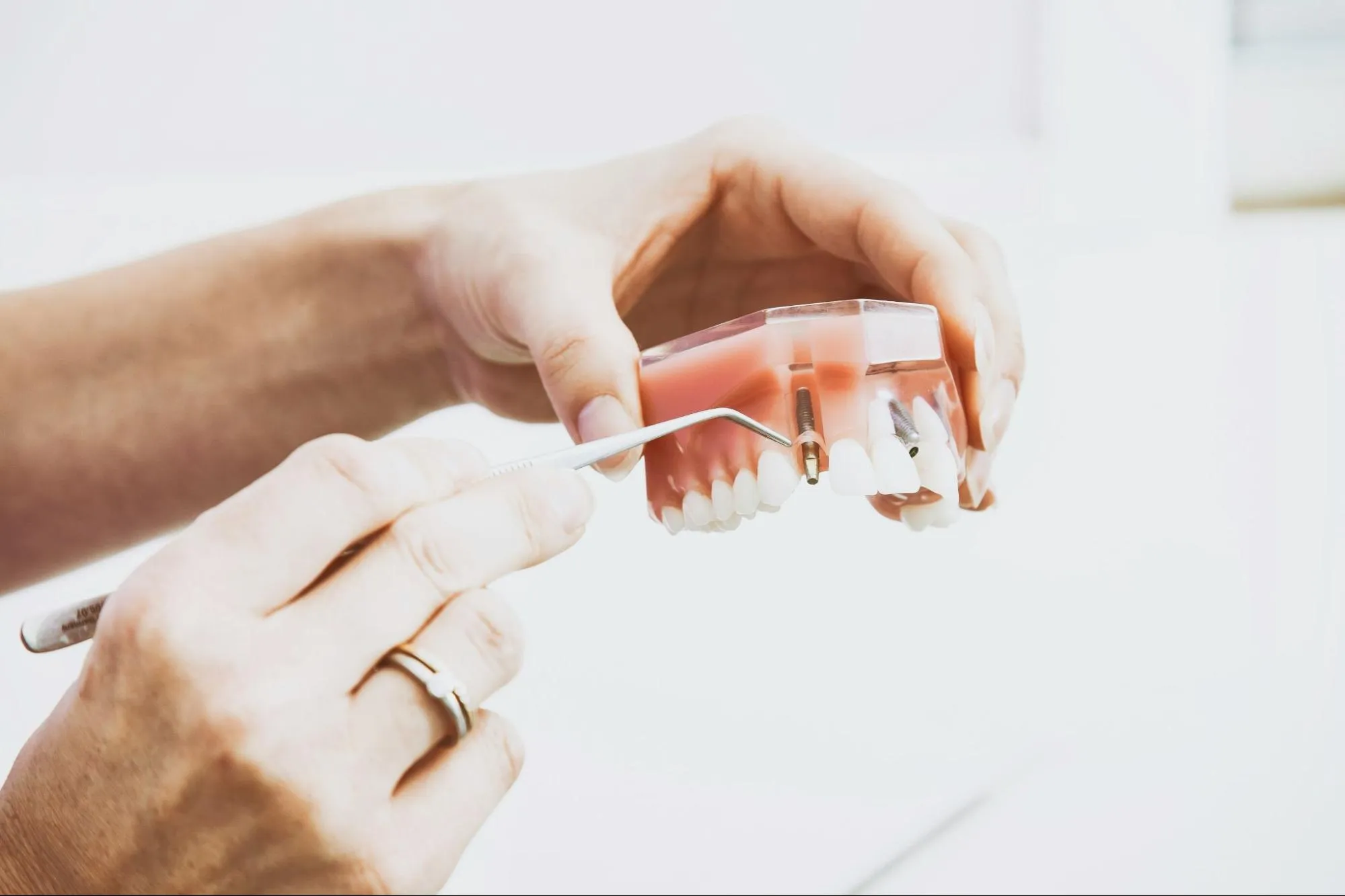 Hands holding dental model with tool demonstrating components of dental implants including posts and abutments inside upper jaw replica.