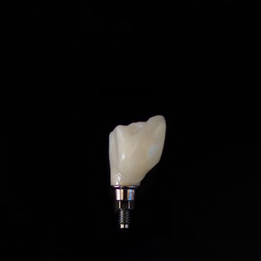 Single dental implant fell out showing a single tooth implant with crown and metal post against a black background.