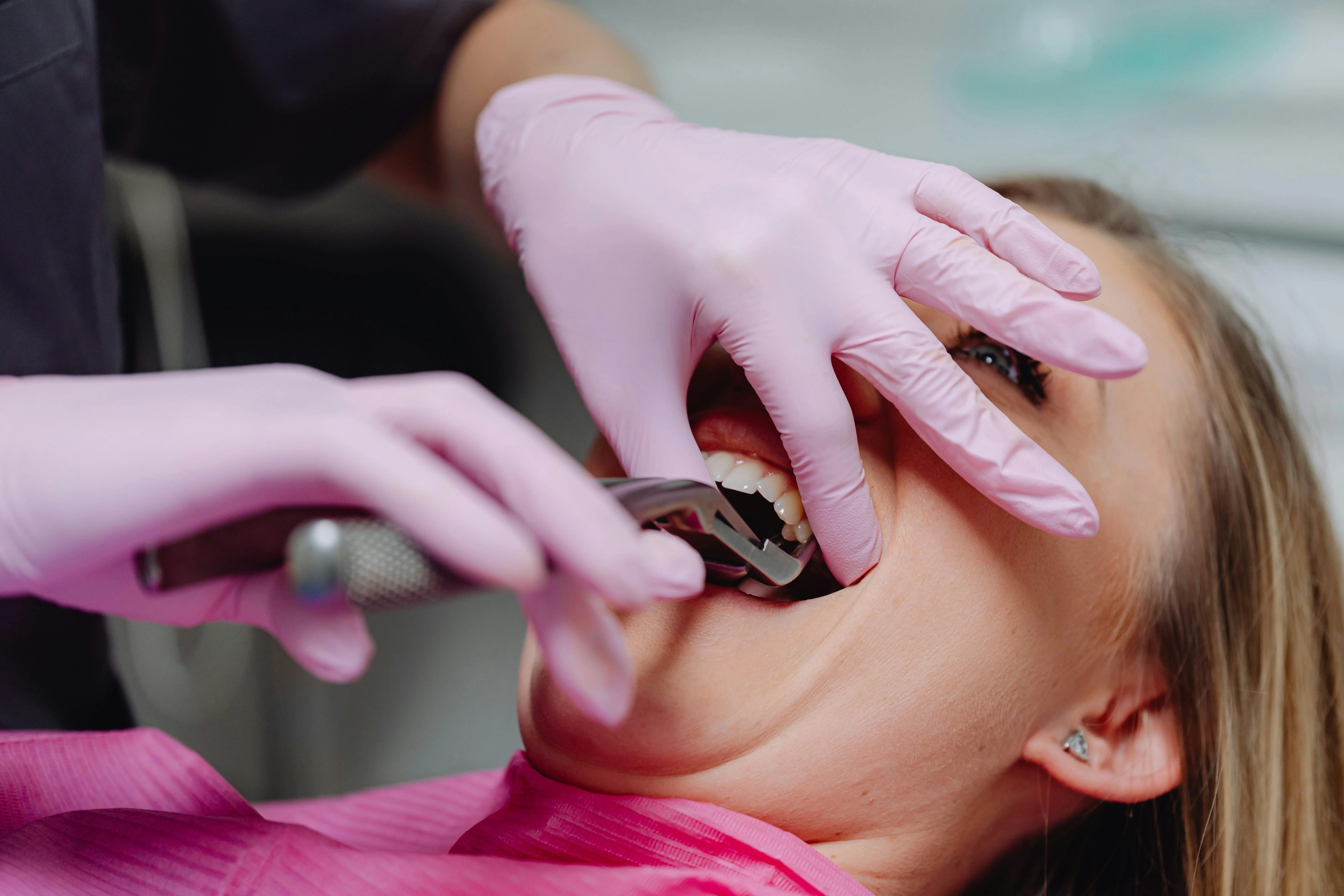 Will a dentist pull an infected tooth the same day? - Dental professional using forceps to extract tooth from patient’s top jaw.