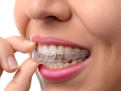 Close up of person inserting clear aligner over upper teeth showing orthodontic treatment process for straightening teeth at home.