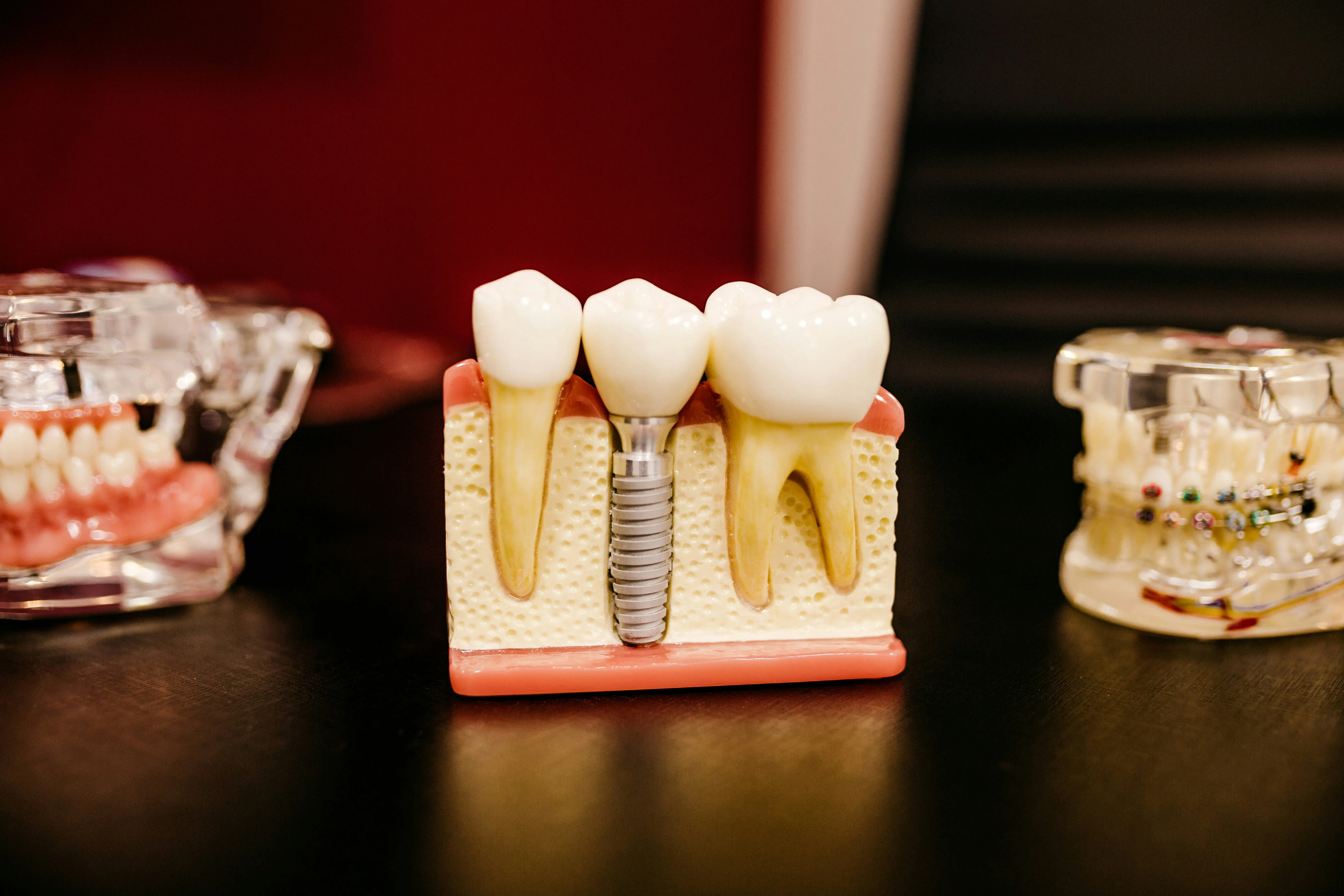 Dental implant model displaying artificial tooth between natural teeth on black surface with orthodontic and denture models in background.