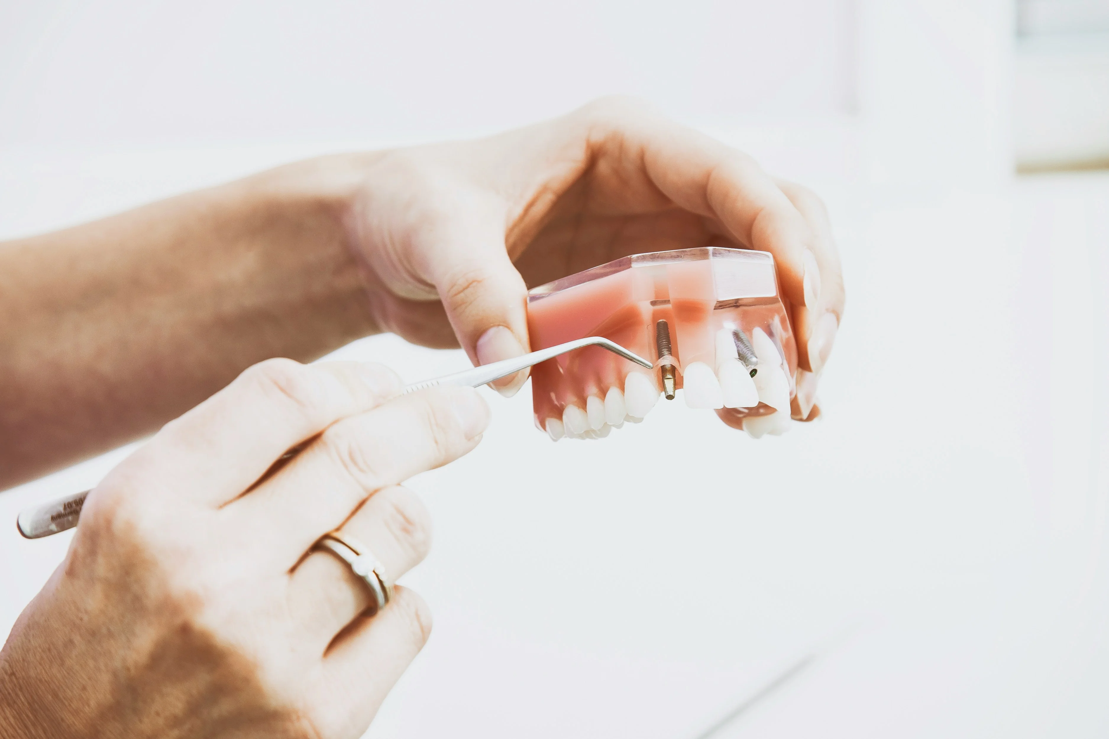 Hands showing dental implant placement on upper jaw model using tool to show how all on 4 dental procedure supports prosthetic teeth for tooth replacement.
    
