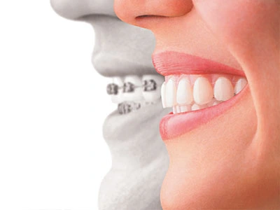 Invisalign vs Braces Banner