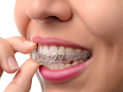 Invisalign vs Consumer Banner