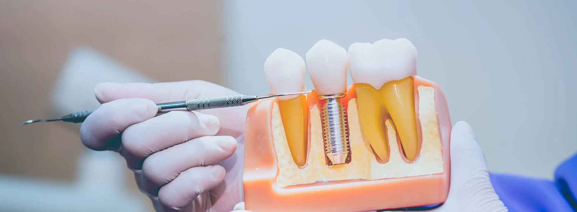 Implant Restorations